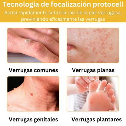 2x1 LOVILDS™  Eliminador de Verrugas y Manchas